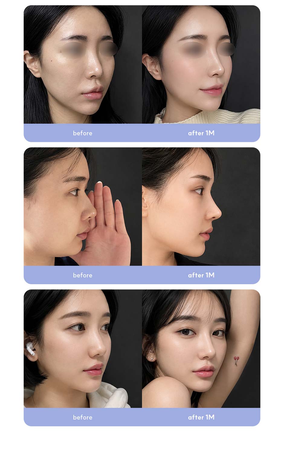 첫코성형_미인하이_08.jpg