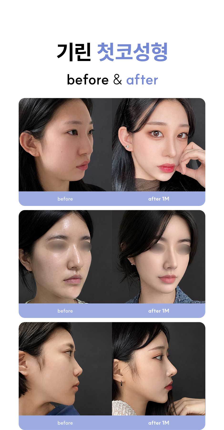 첫코성형_미인하이_07.jpg