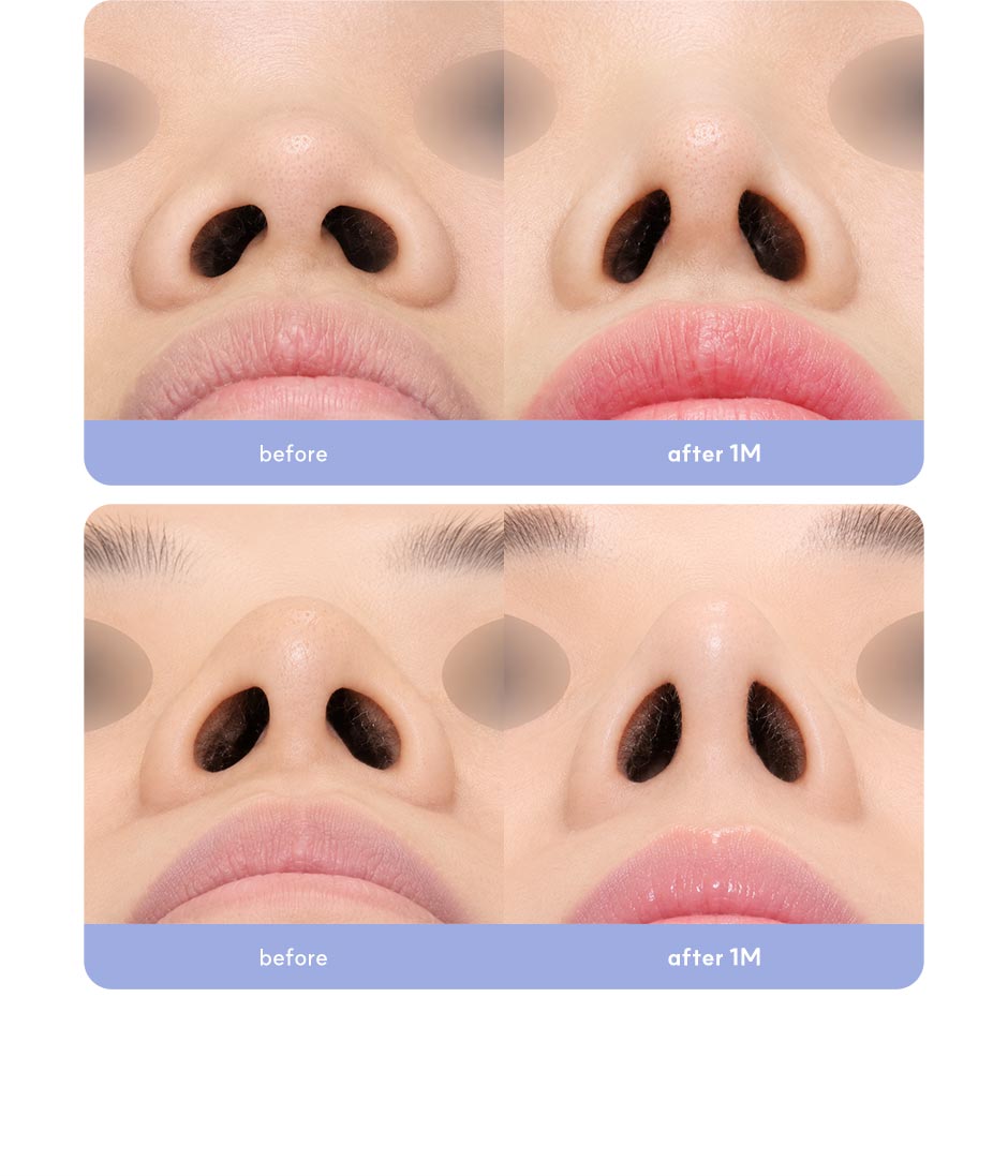 첫코성형_미인하이_10.jpg