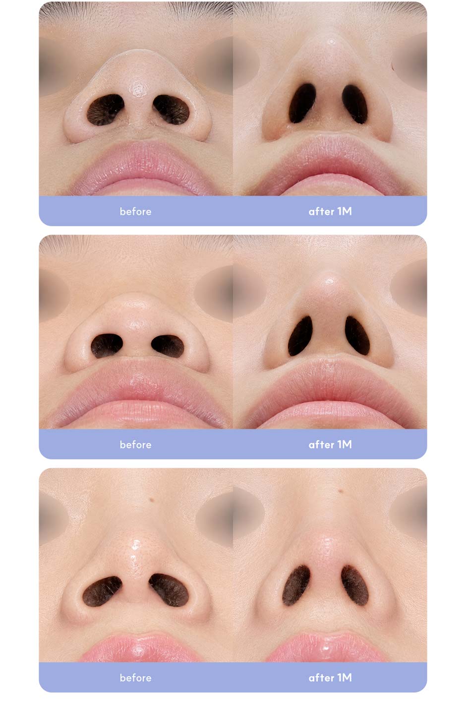 첫코성형_미인하이_09.jpg