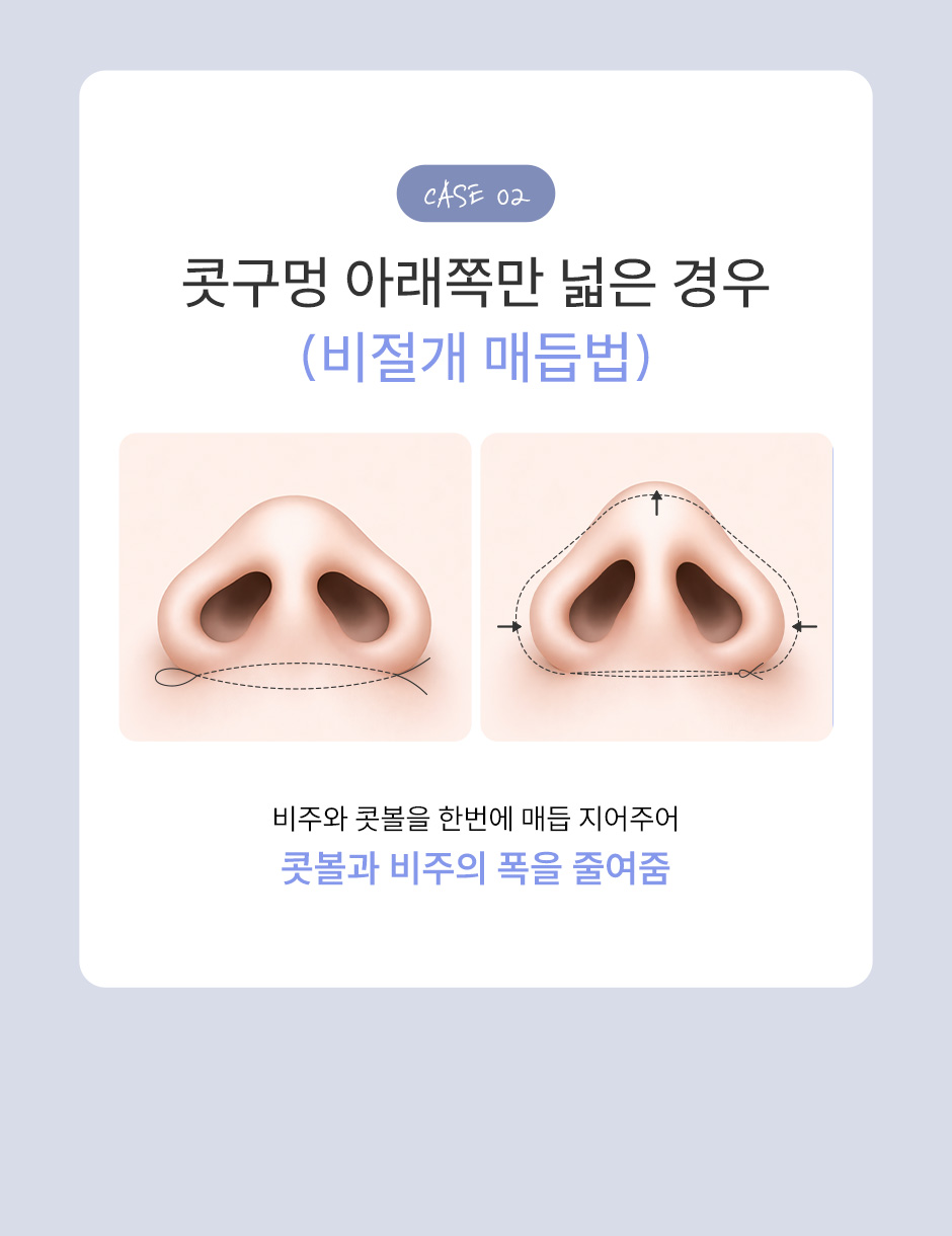 콧볼축소_미인하이_06.jpg