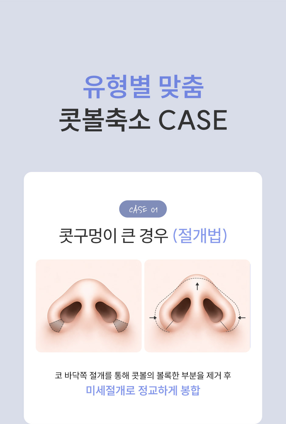 콧볼축소_미인하이_05.jpg