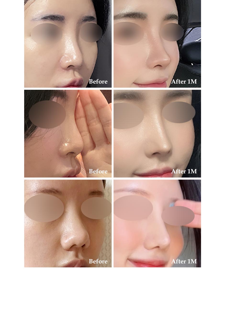 프리미엄보형물_미인하이_07.jpg