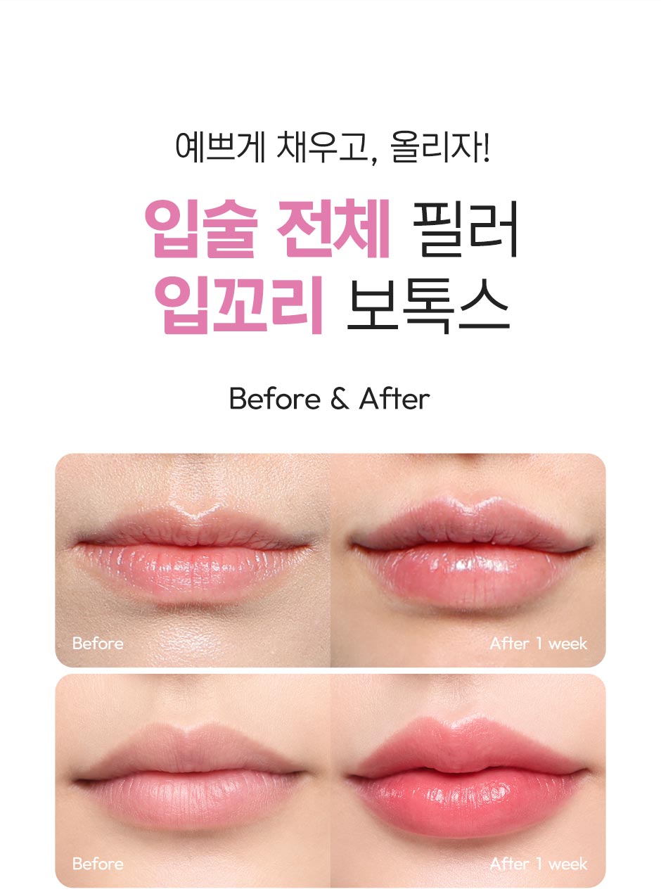 입술입꼬리필러_미인하이_05.jpg