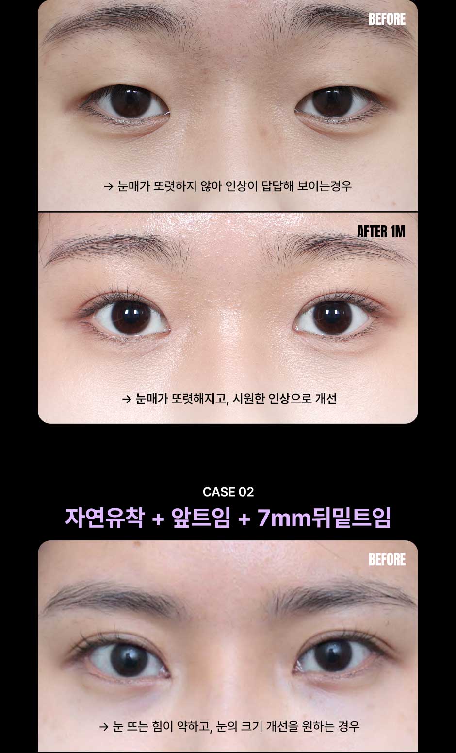 눈성형_미인하이_05.jpg