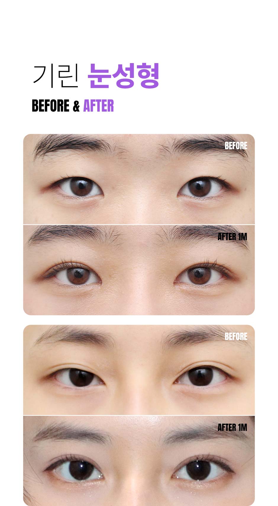 눈성형_미인하이_08.jpg