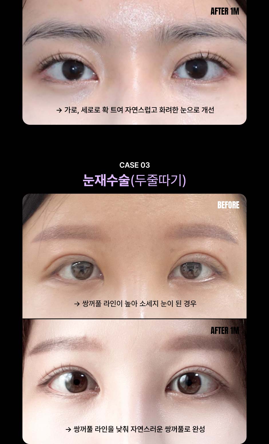 눈성형_미인하이_06.jpg