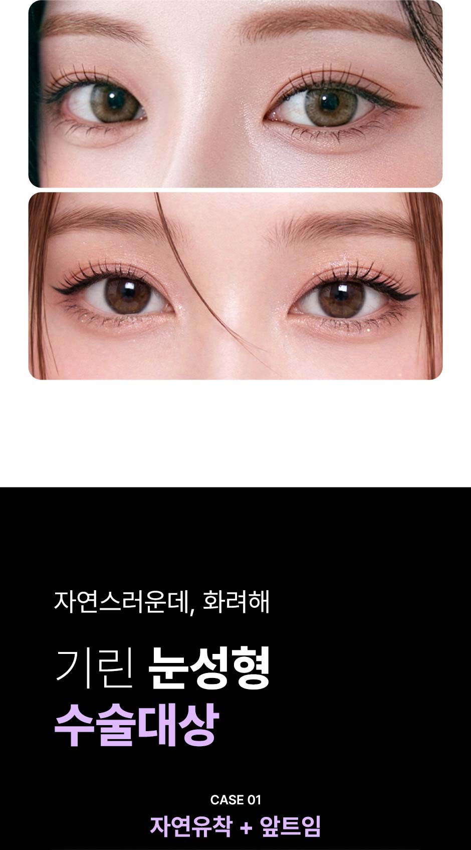 눈성형_미인하이_04.jpg