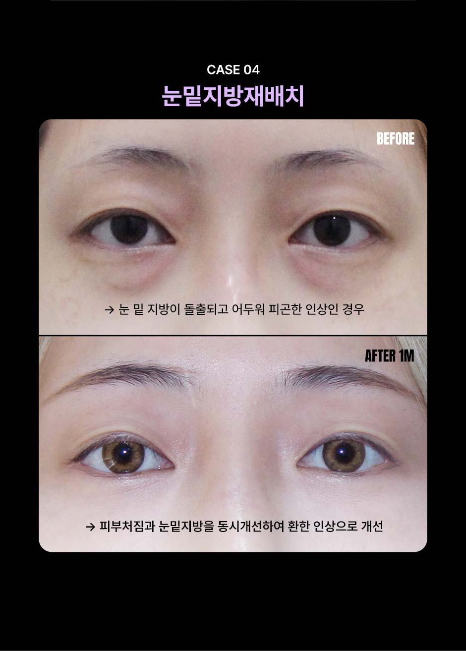 눈성형_미인하이_07.jpg
