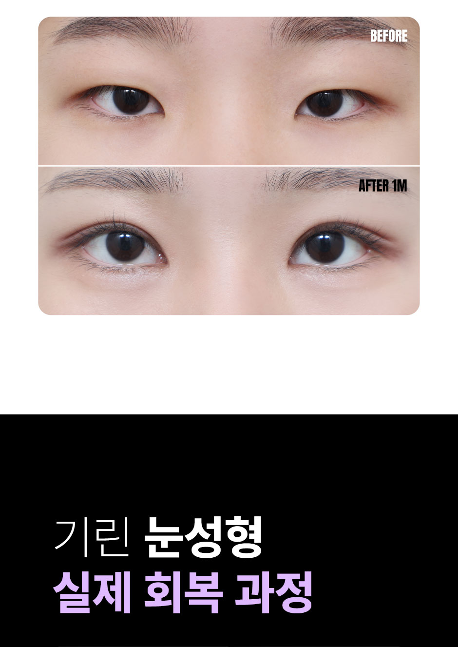 눈성형_미인하이_10.jpg