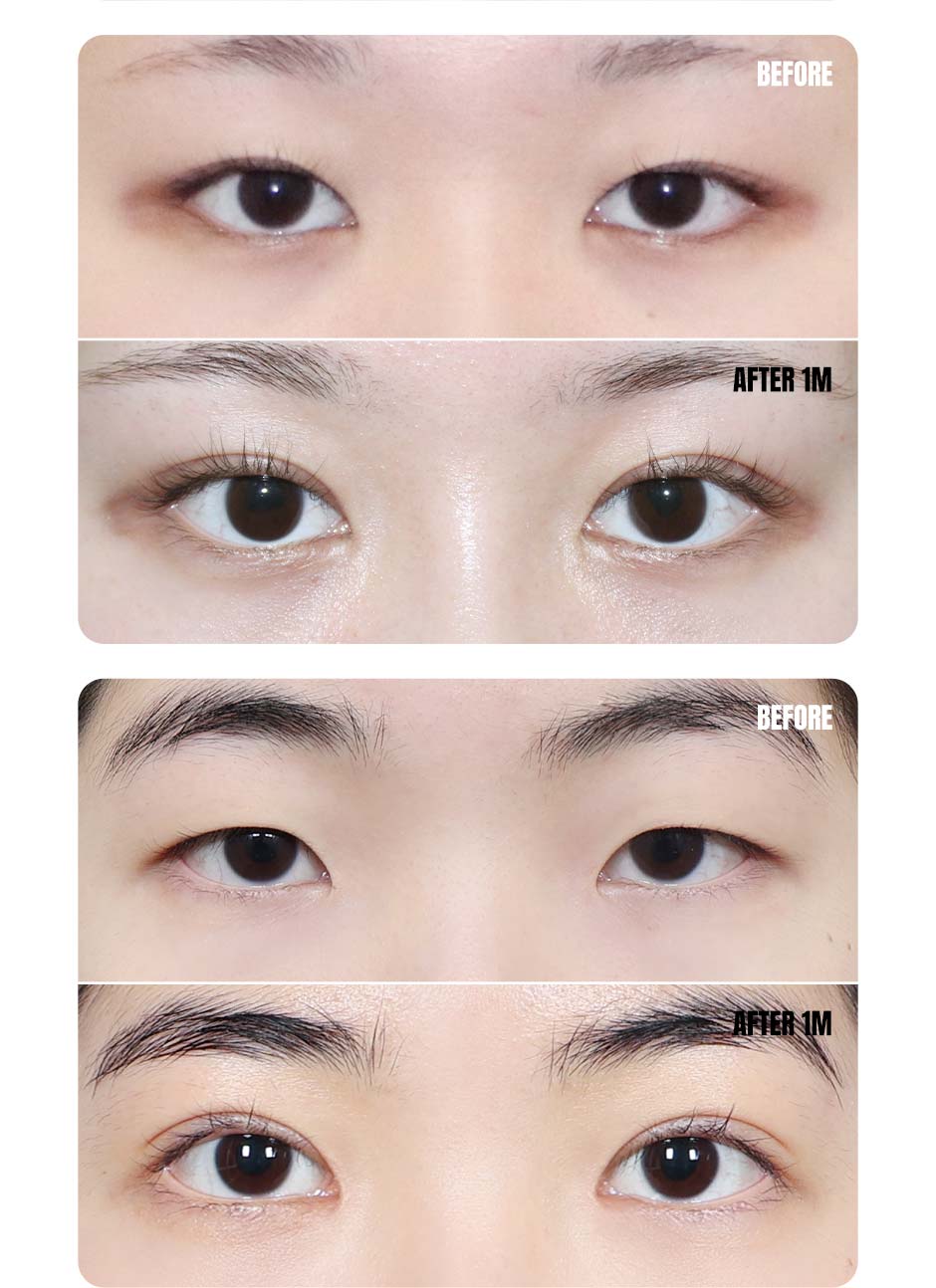 눈성형_미인하이_09.jpg