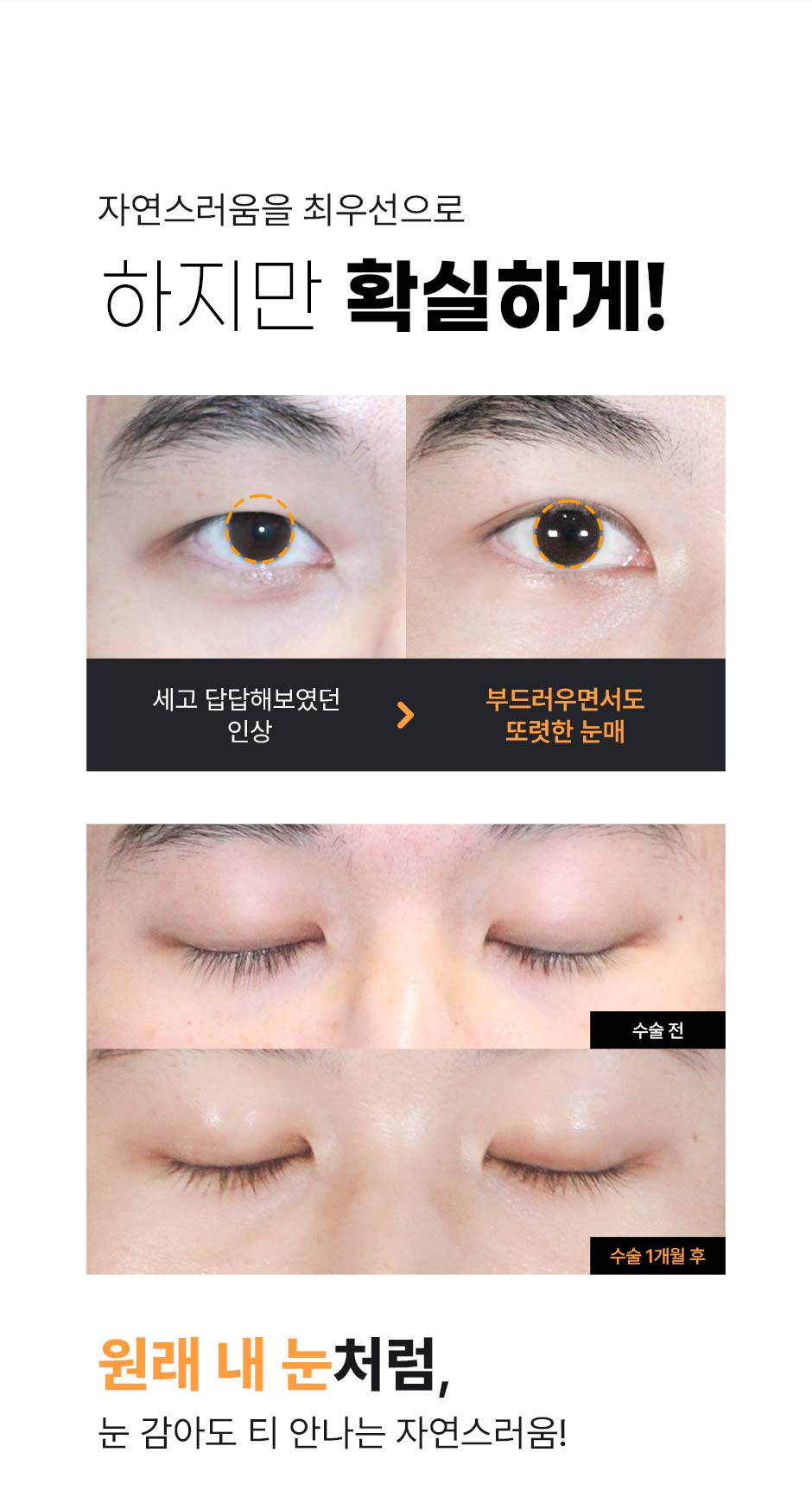 남자눈성형_07.jpg