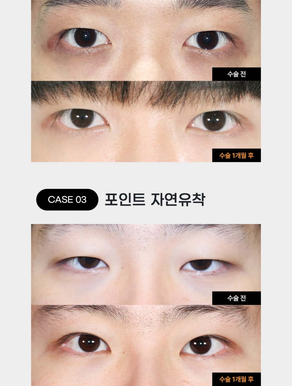 남자눈성형_05.jpg