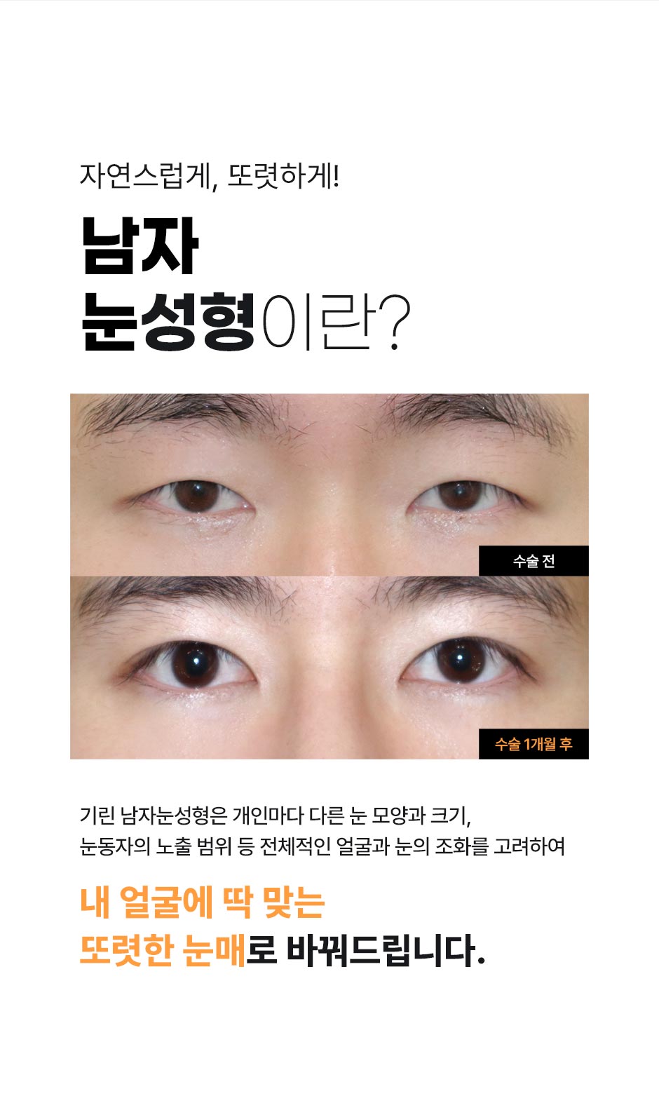 남자눈성형_03.jpg