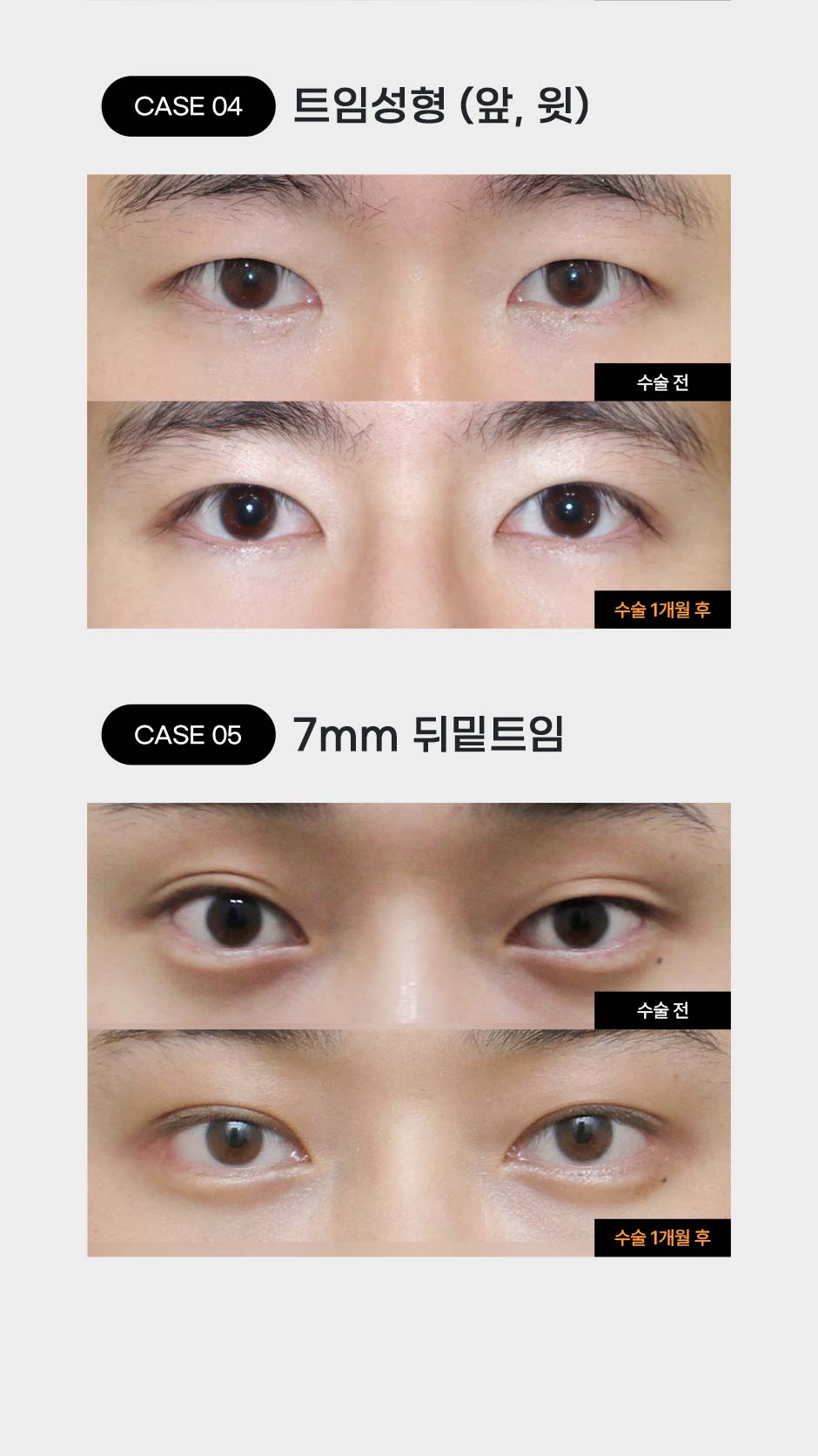 남자눈성형_06.jpg