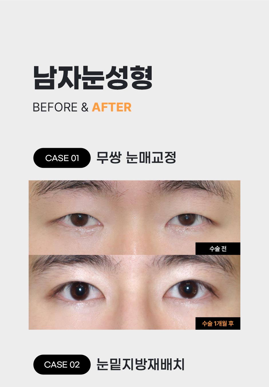 남자눈성형_04.jpg