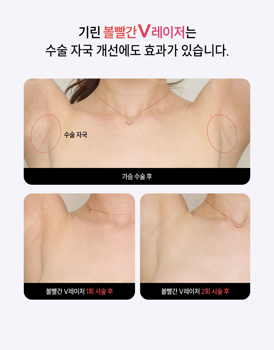 볼빨간V레이저_미인하이_06.jpg