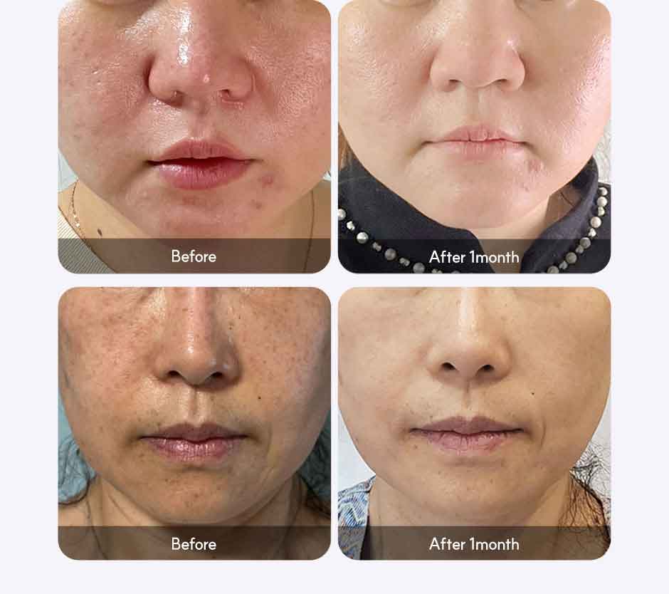 볼빨간V레이저_미인하이_05.jpg