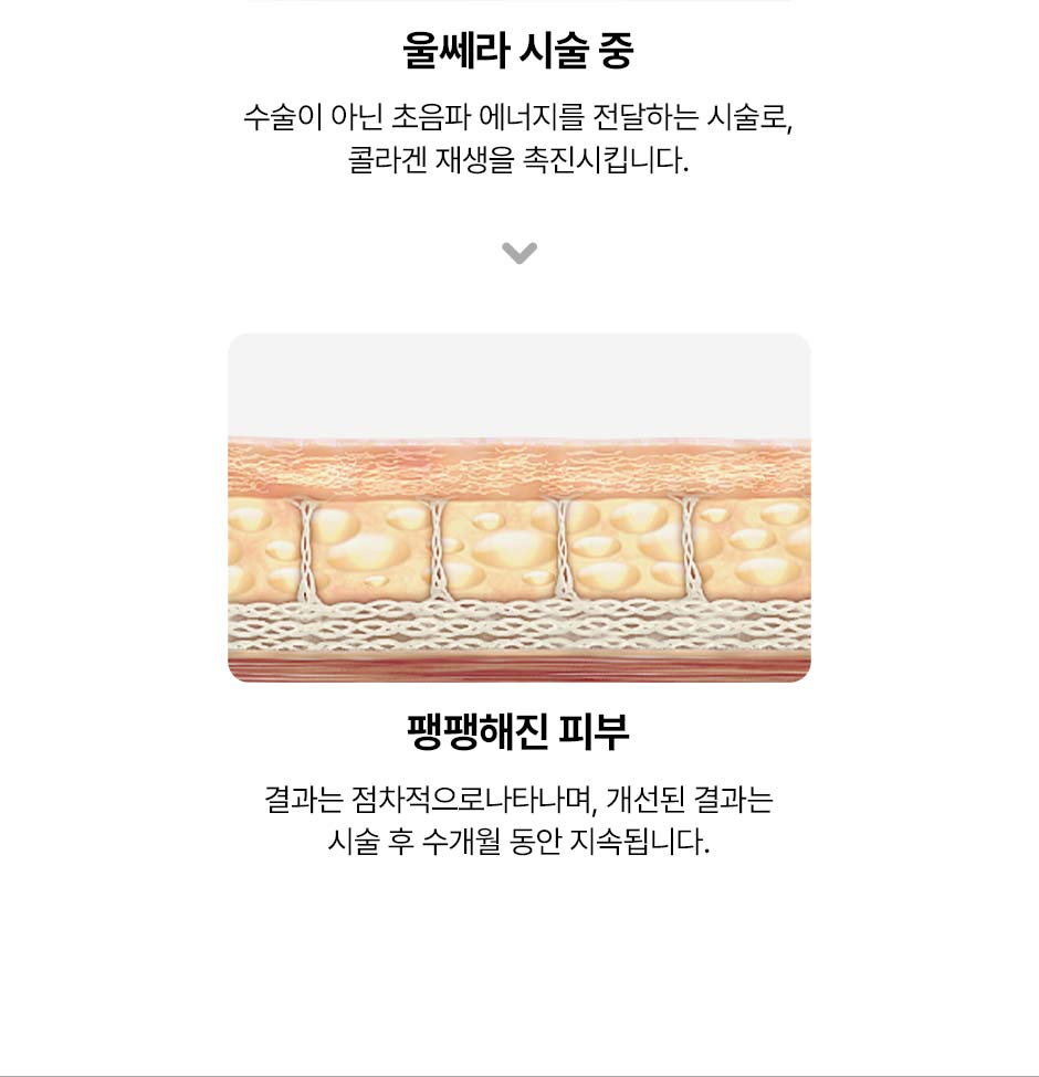 울쎄라피프라임_미인하이_11.jpg