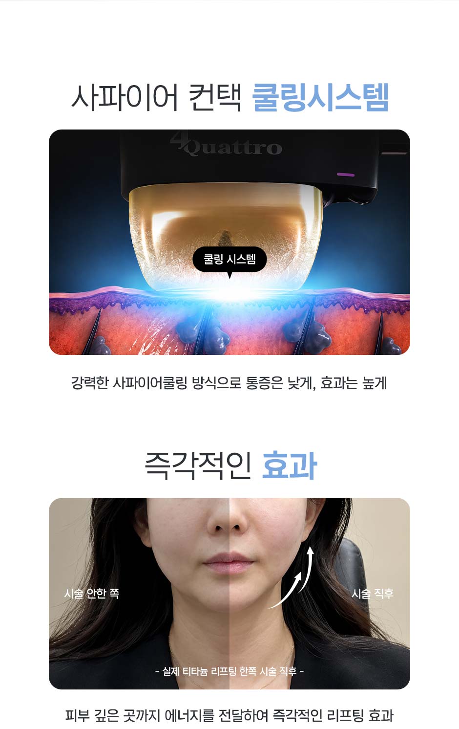 티타늄리프팅_미인하이_09.jpg