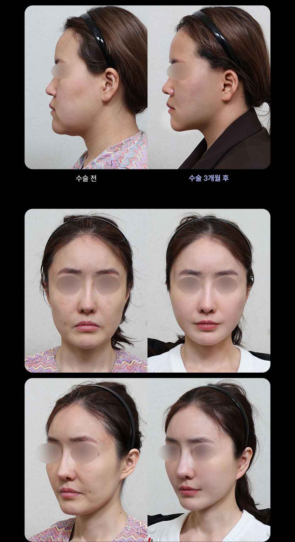 연조직윤곽술_미인하이_09.jpg