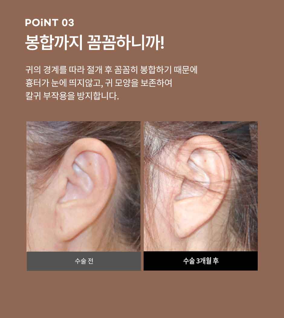 안면거상_미인하이_06.jpg