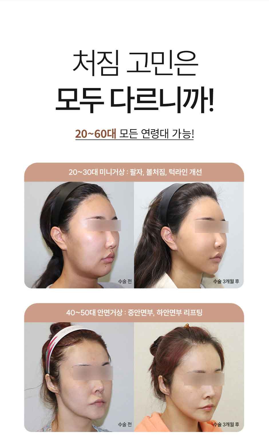 안면거상_미인하이_03.jpg