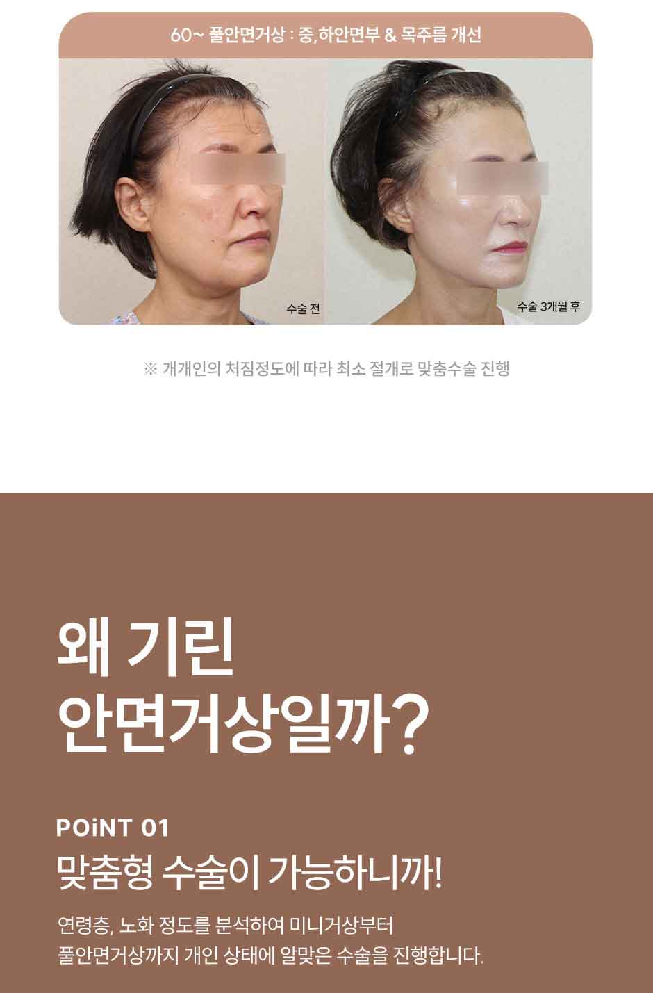 안면거상_미인하이_04.jpg