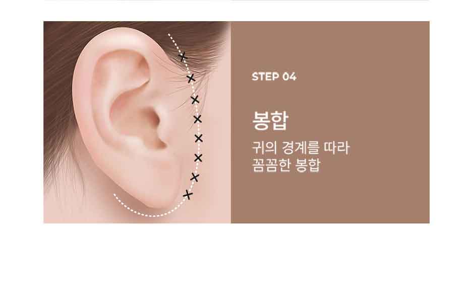 안면거상_미인하이_08.jpg