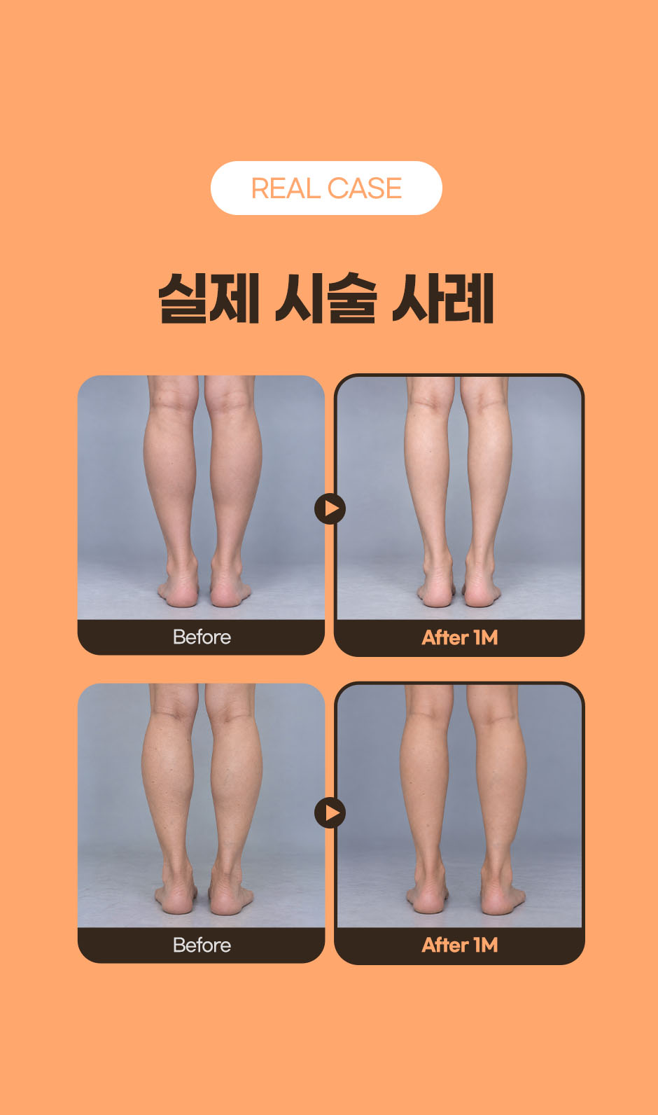 260917_알피스주사_미인하이06.jpg