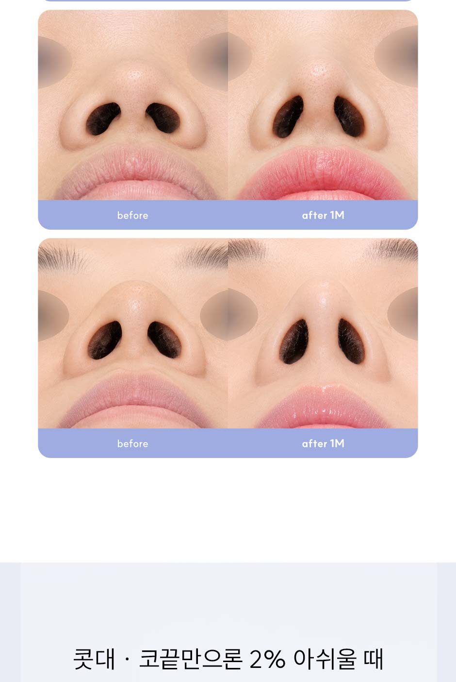 첫코성형_미인하이_10.jpg