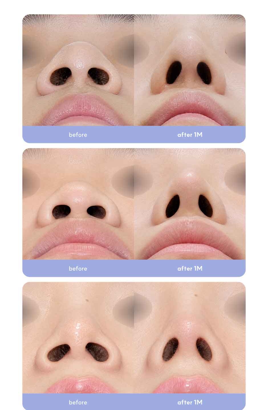 첫코성형_미인하이_09.jpg