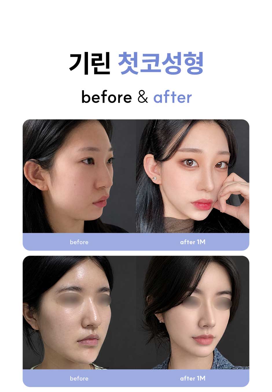 첫코성형_미인하이_07.jpg