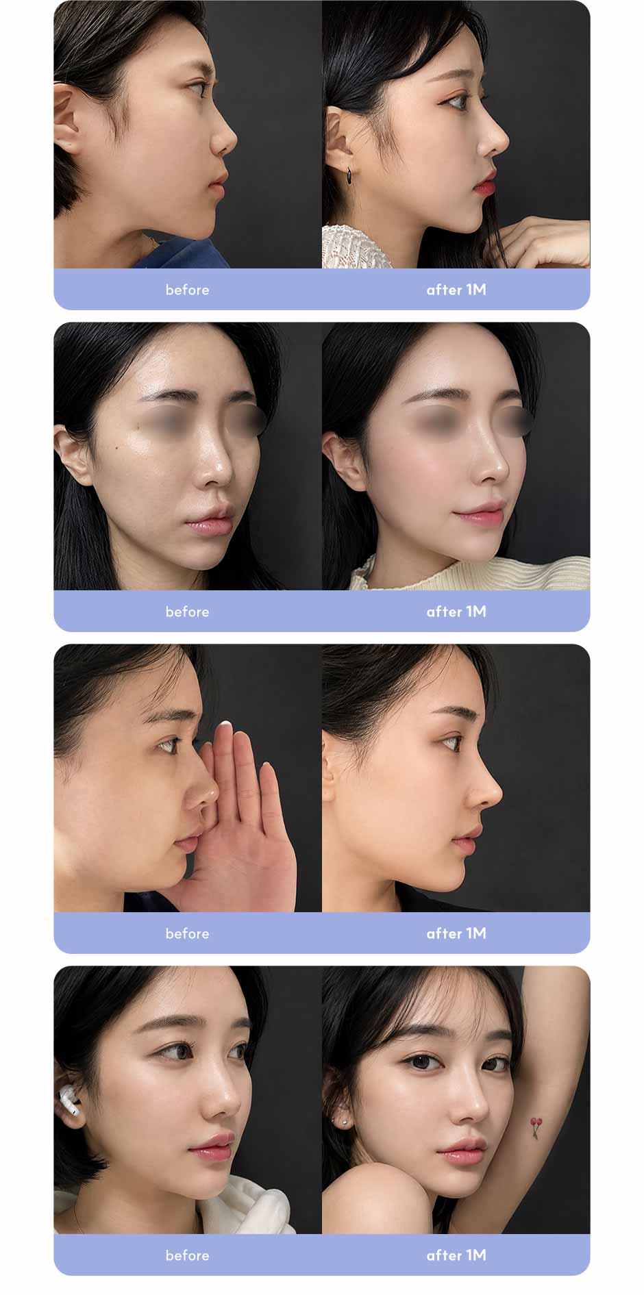 첫코성형_미인하이_08.jpg