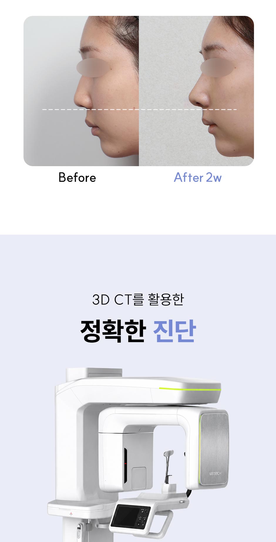 첫코성형_미인하이_13.jpg