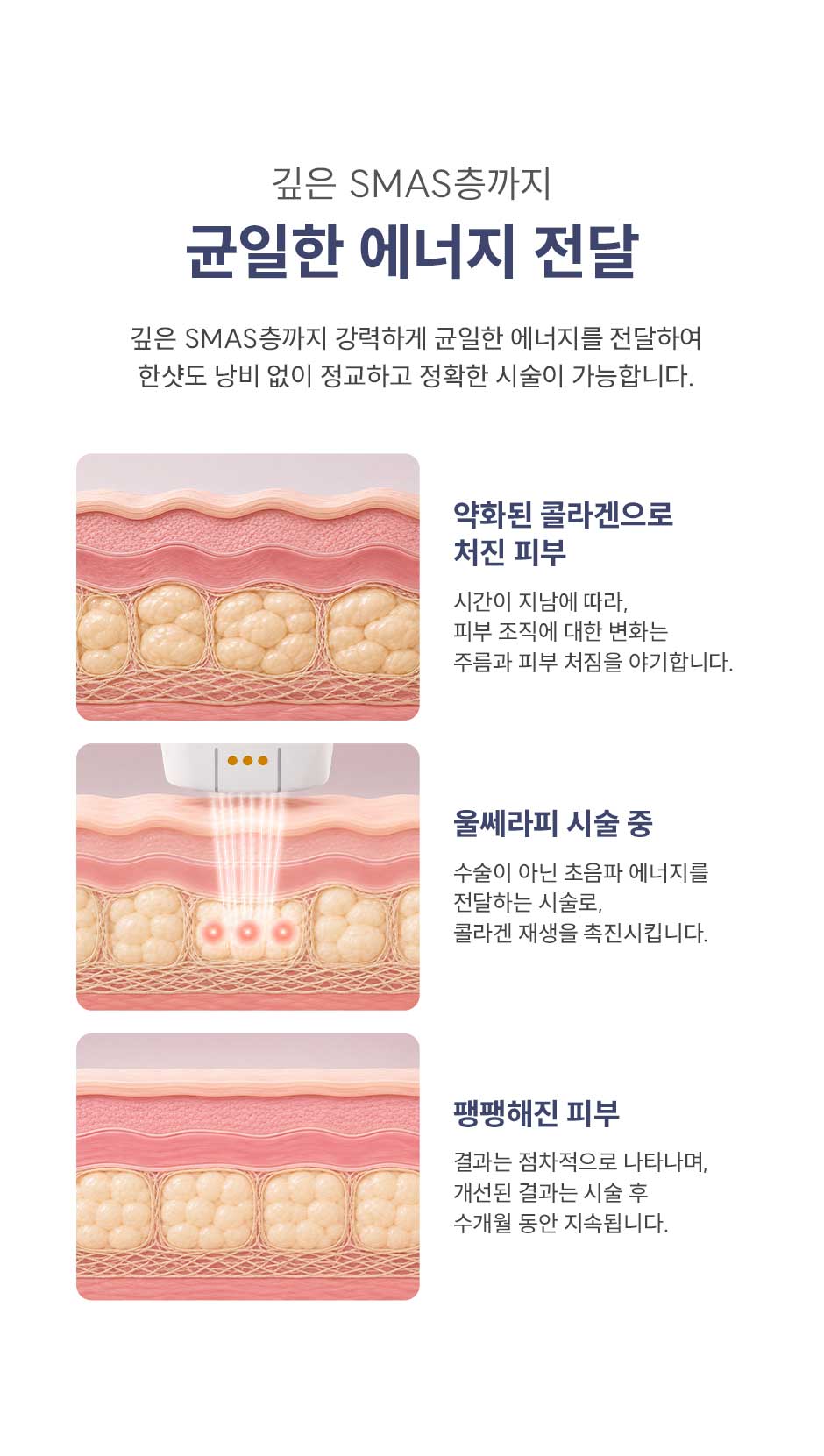 울쎄라피프라임_미인하이_11.jpg