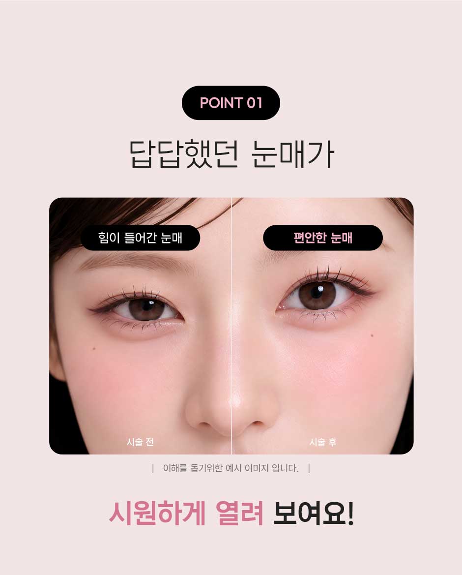 큰눈보톡스_미인하이_08.jpg